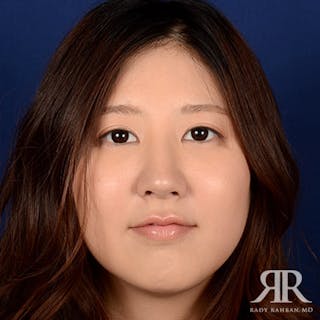 Female Rhinoplasty Before & After Gallery - Patient 337652 - Image 2
