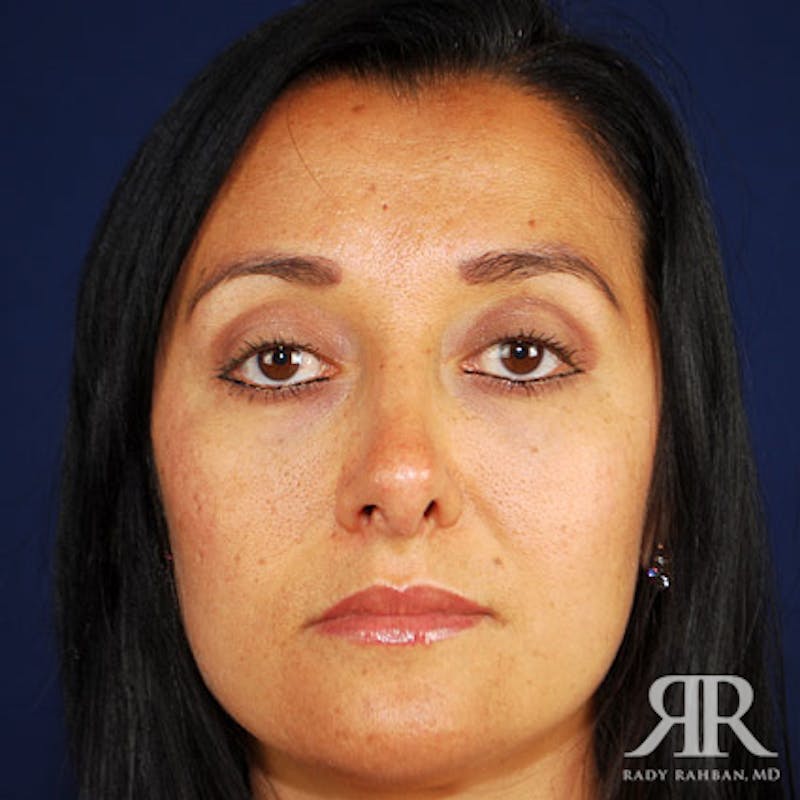 Ethnic Rhinoplasty Before & After Gallery - Patient 209098 - Image 2