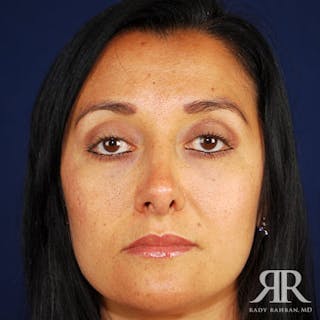 Ethnic Rhinoplasty Before & After Gallery - Patient 209098 - Image 2