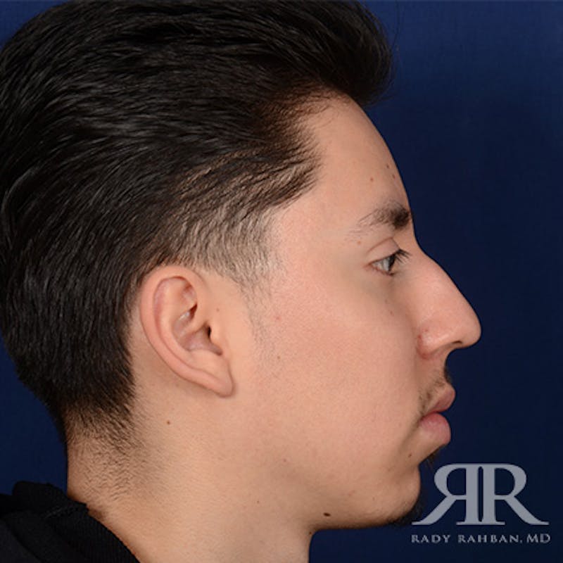 Chin Augmentation Before & After Gallery - Patient 428154 - Image 5