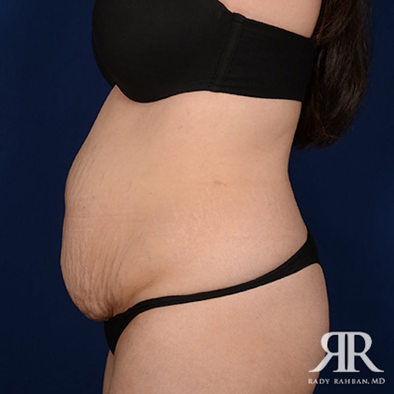 Severe Diastasis Recti Before & After Gallery - Patient 153551 - Image 5