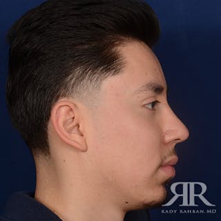 Chin Augmentation Before & After Gallery - Patient 428154 - Image 6