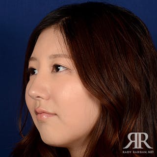 Female Rhinoplasty Before & After Gallery - Patient 337652 - Image 4