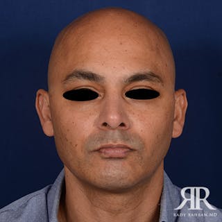 Chin Augmentation Before & After Gallery - Patient 414566 - Image 2