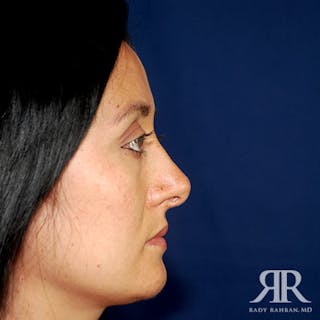 Ethnic Rhinoplasty Before & After Gallery - Patient 209098 - Image 6