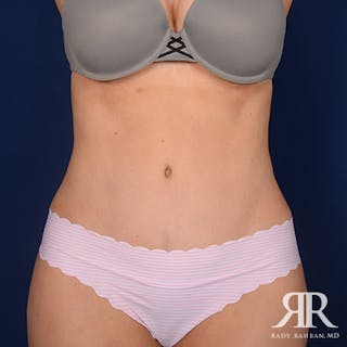 Severe Diastasis Recti Before & After Gallery - Patient 493788 - Image 2