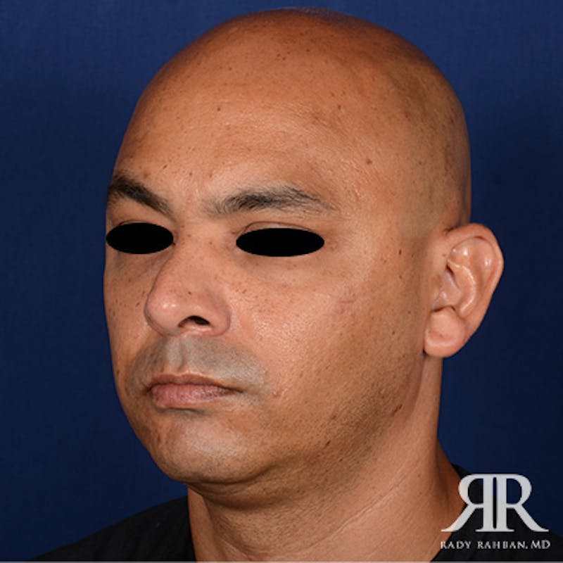 Chin Augmentation Before & After Gallery - Patient 414566 - Image 3
