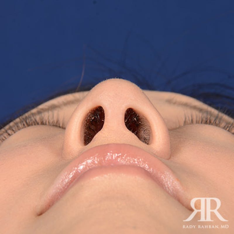Female Rhinoplasty Before & After Gallery - Patient 337652 - Image 8