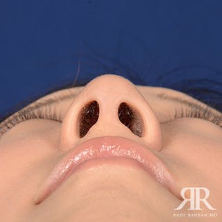 Female Rhinoplasty Before & After Gallery - Patient 337652 - Image 8