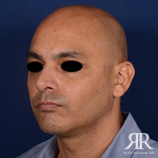 Chin Augmentation Before & After Gallery - Patient 414566 - Image 4