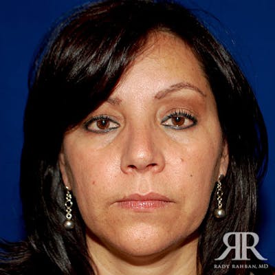 Ethnic Rhinoplasty Before & After Gallery - Patient 822678 - Image 2