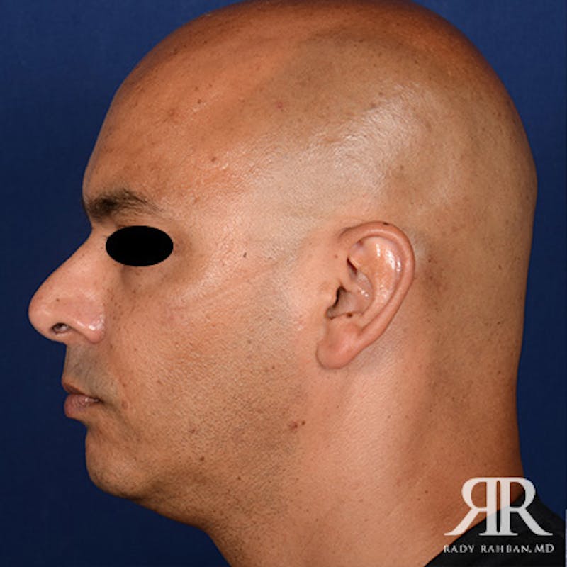 Chin Augmentation Before & After Gallery - Patient 414566 - Image 5