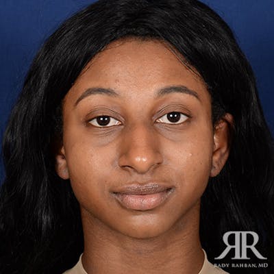 Female Rhinoplasty Before & After Gallery - Patient 287694 - Image 1