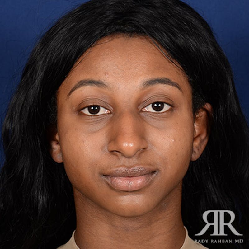 Female Rhinoplasty Before & After Gallery - Patient 287694 - Image 1