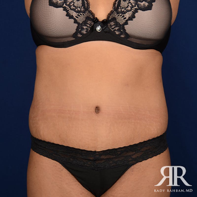 Tummy Tuck Before & After Gallery - Patient 411124 - Image 2