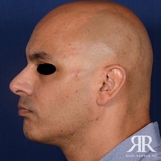 Chin Augmentation Before & After Gallery - Patient 414566 - Image 6