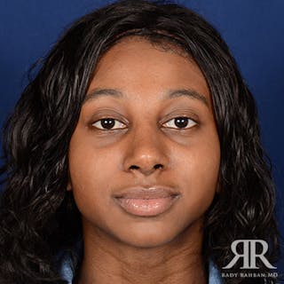 Female Rhinoplasty Before & After Gallery - Patient 287694 - Image 2
