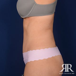 Severe Diastasis Recti Before & After Gallery - Patient 493788 - Image 6