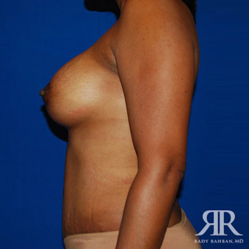 Mommy Makeover Before & After Gallery - Patient 138759 - Image 4
