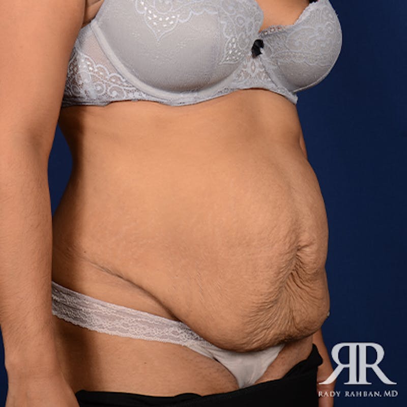 Tummy Tuck Before & After Gallery - Patient 411124 - Image 3