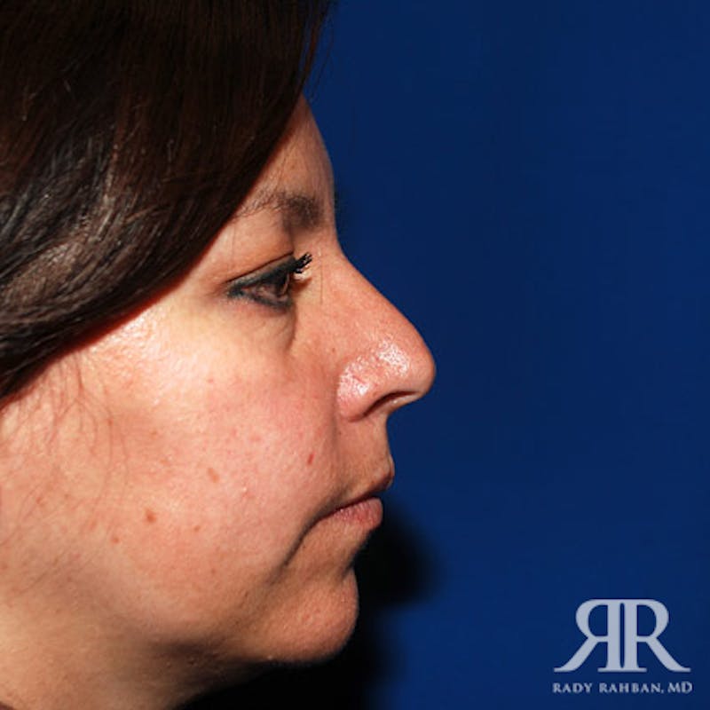 Ethnic Rhinoplasty Before & After Gallery - Patient 822678 - Image 5