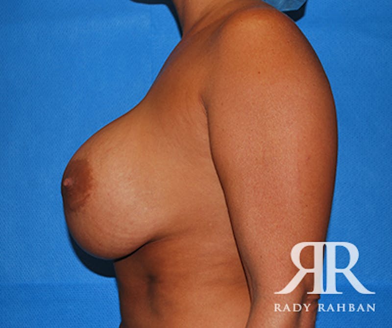 Corrective Breast Surgery Before & After Gallery - Patient 660047 - Image 3