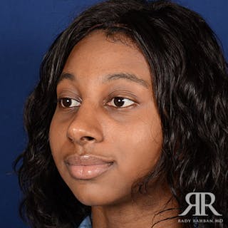 Female Rhinoplasty Before & After Gallery - Patient 287694 - Image 4