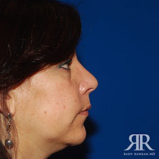 Ethnic Rhinoplasty Before & After Gallery - Patient 822678 - Image 6
