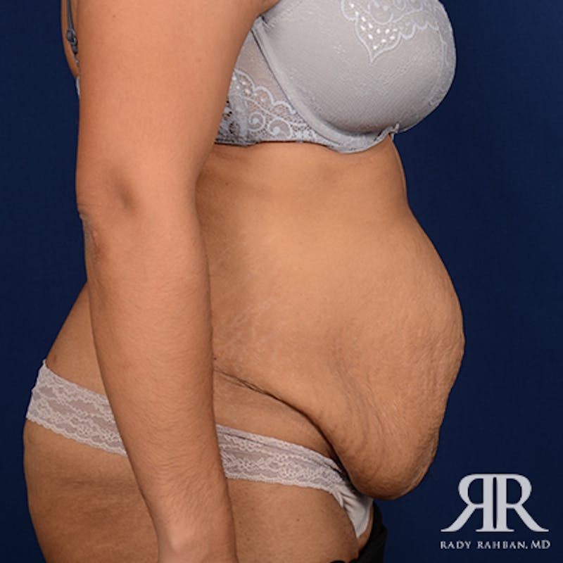 Tummy Tuck Before & After Gallery - Patient 411124 - Image 5