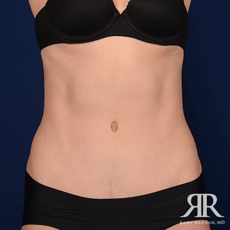 Severe Diastasis Recti Before & After Gallery - Patient 385766 - Image 2