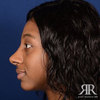 Female Rhinoplasty Before & After Gallery - Patient 287694 - Image 6