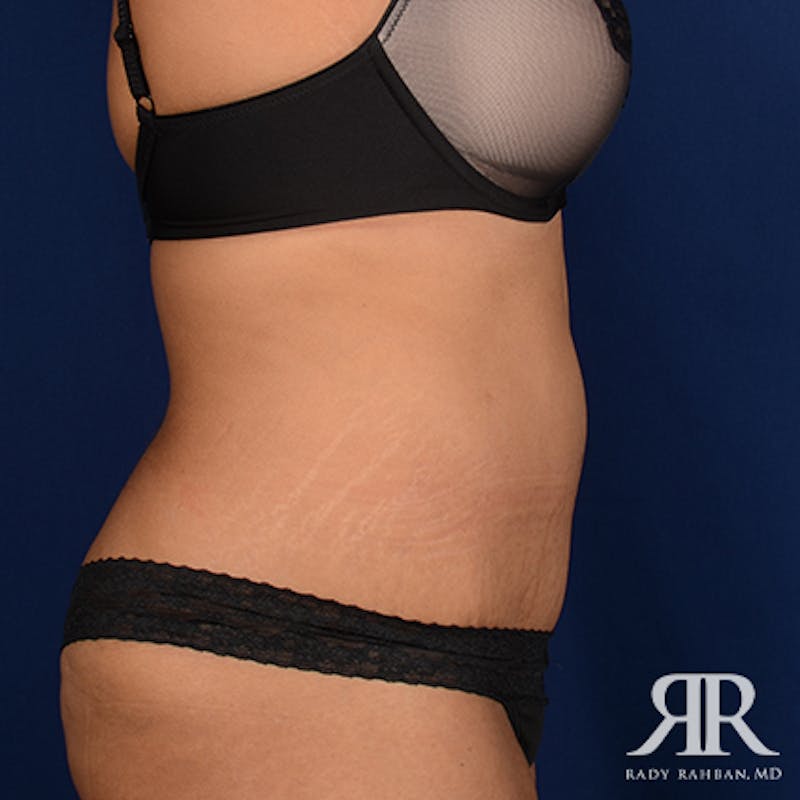 Tummy Tuck Before & After Gallery - Patient 411124 - Image 6