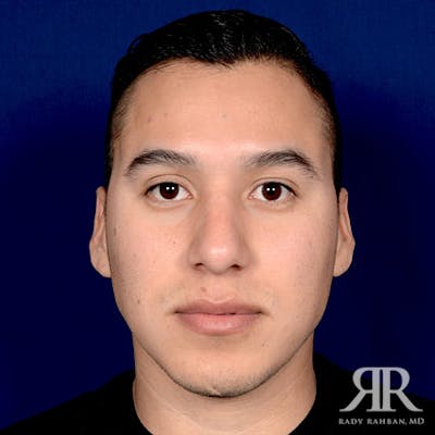 Ethnic Rhinoplasty Before & After Gallery - Patient 306581 - Image 2