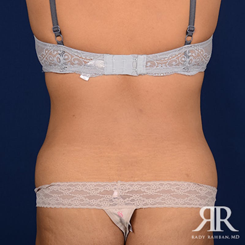 Tummy Tuck Before & After Gallery - Patient 411124 - Image 7