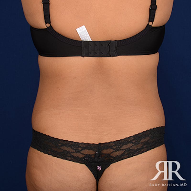 Tummy Tuck Before & After Gallery - Patient 411124 - Image 8