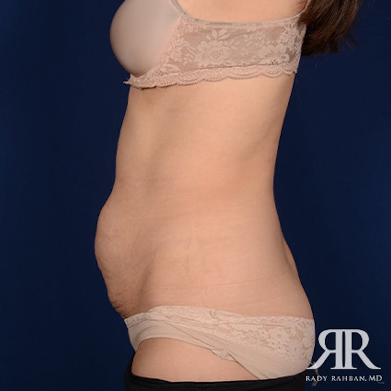 Severe Diastasis Recti Before & After Gallery - Patient 385766 - Image 5