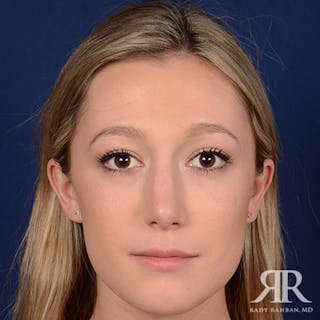Female Rhinoplasty Before & After Gallery - Patient 355223 - Image 2