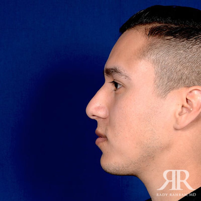 Ethnic Rhinoplasty Before & After Gallery - Patient 306581 - Image 4