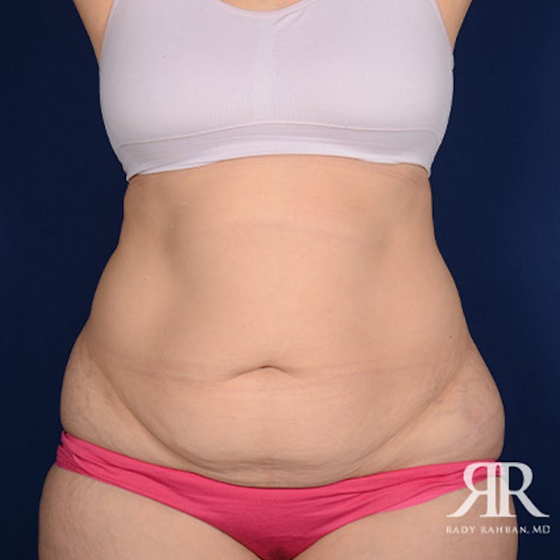Tummy Tuck Before & After Gallery - Patient 378785 - Image 1