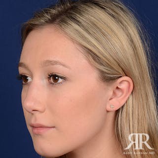 Female Rhinoplasty Before & After Gallery - Patient 355223 - Image 4