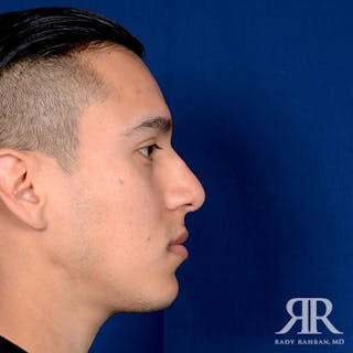 Ethnic Rhinoplasty Before & After Gallery - Patient 306581 - Image 6