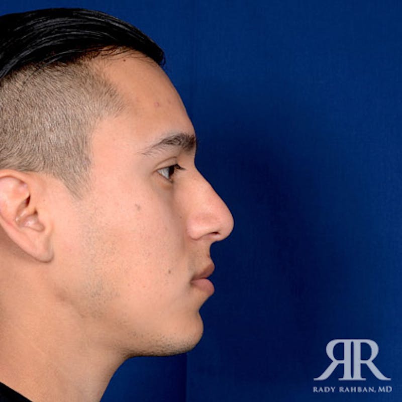 Ethnic Rhinoplasty Before & After Gallery - Patient 306581 - Image 6