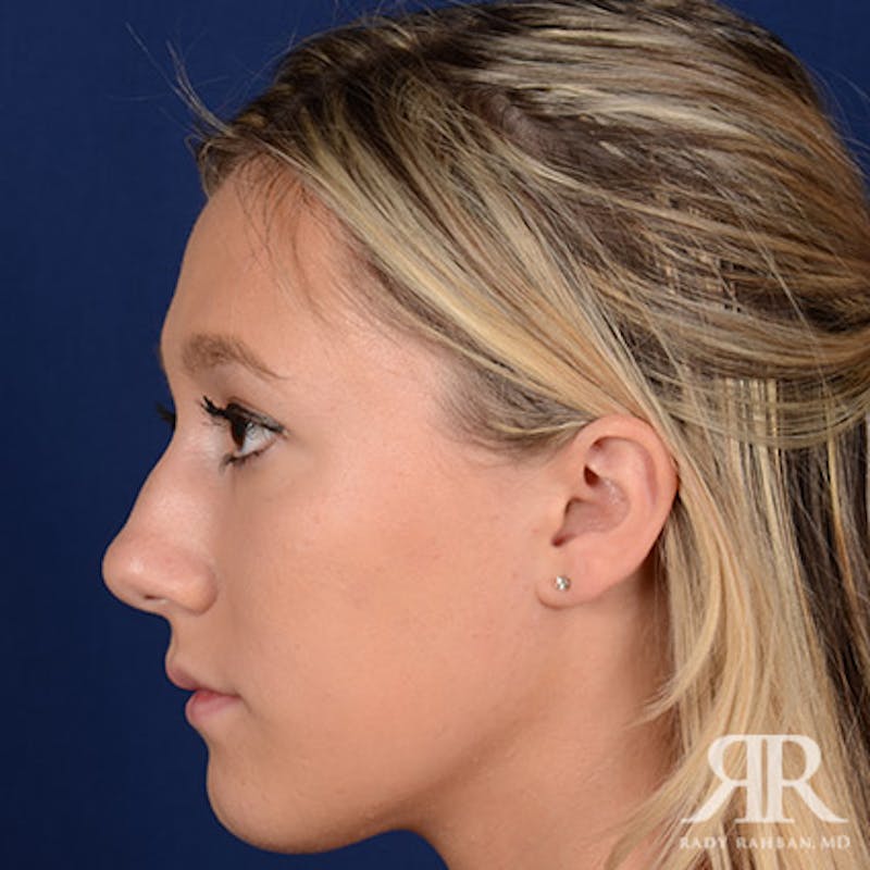 Female Rhinoplasty Before & After Gallery - Patient 355223 - Image 5