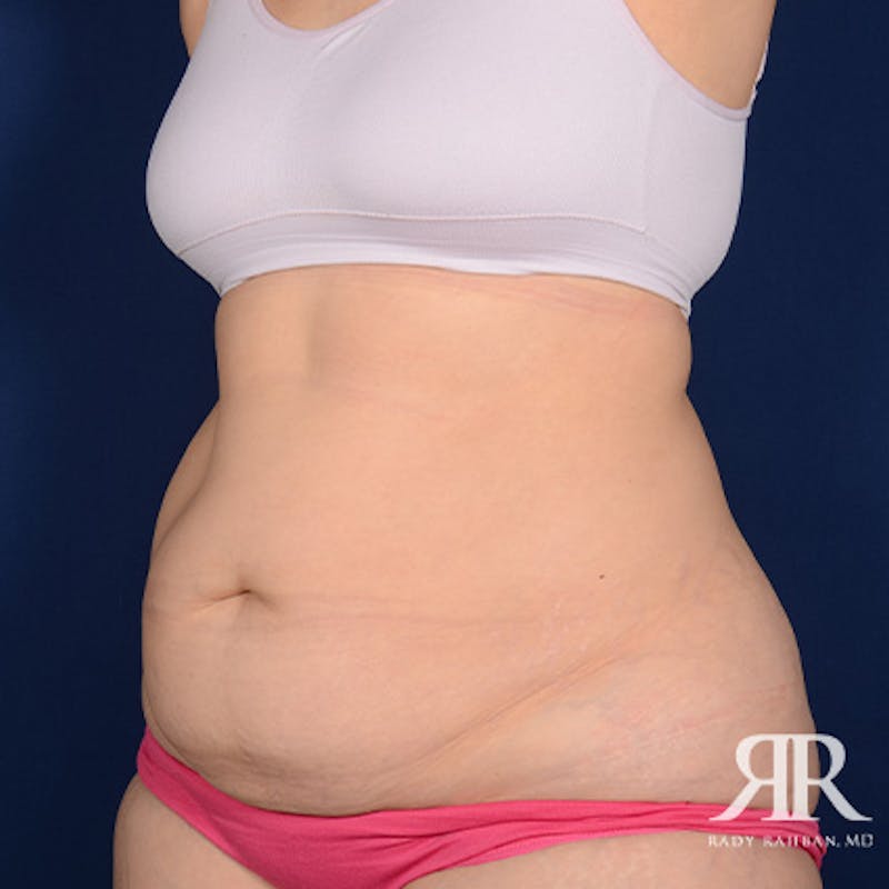 Tummy Tuck Before & After Gallery - Patient 378785 - Image 3