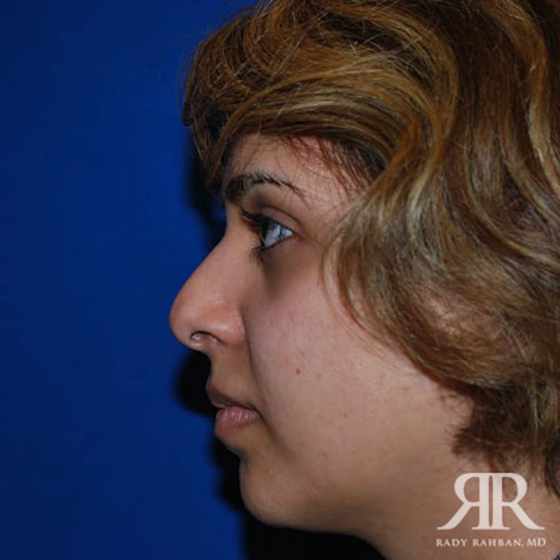 Ethnic Rhinoplasty Before & After Gallery - Patient 417186 - Image 1