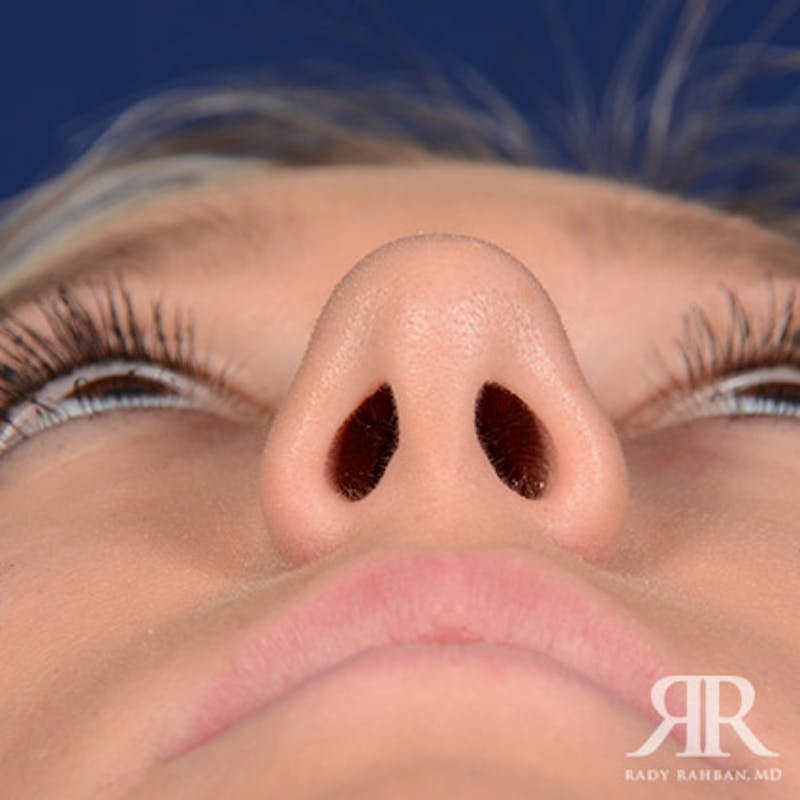 Female Rhinoplasty Before & After Gallery - Patient 355223 - Image 7