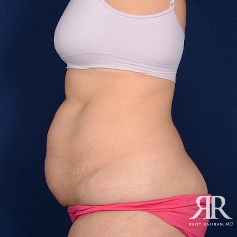 Tummy Tuck Before & After Gallery - Patient 378785 - Image 5