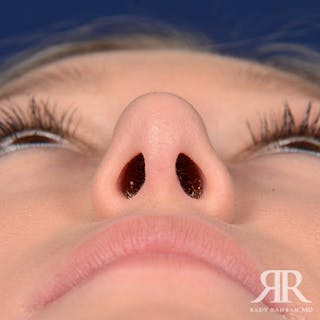 Female Rhinoplasty Before & After Gallery - Patient 355223 - Image 8