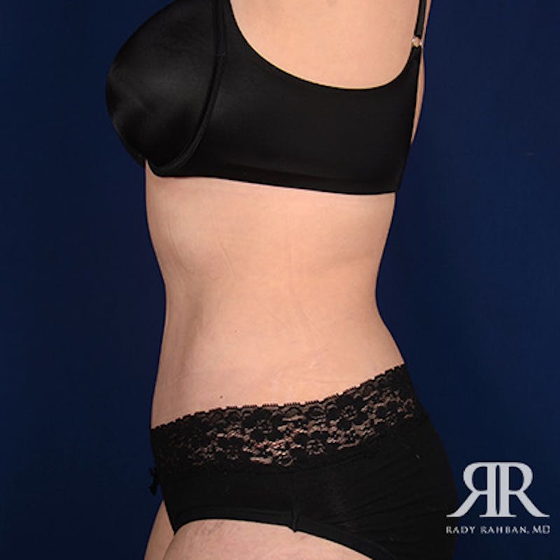 Tummy Tuck Before & After Gallery - Patient 378785 - Image 6
