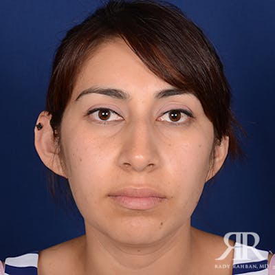 Ethnic Rhinoplasty Before & After Gallery - Patient 913976 - Image 1